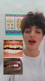 تجميل أسنان مباشر بالعيادة 
تجميل أسنان بجلسة واحدة 
فينير مباشر 🤍🦷?